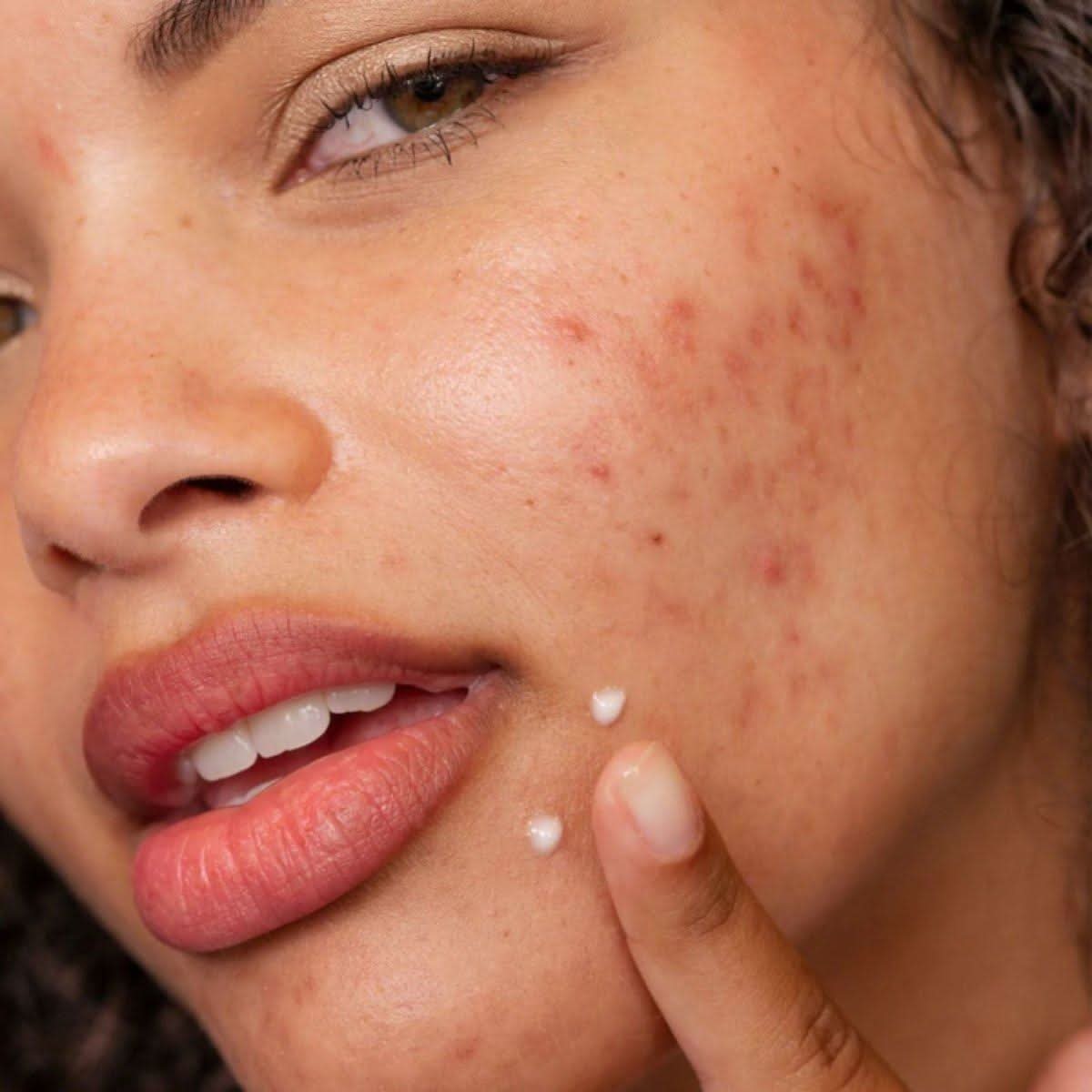 Dermalogica Clear Start Post-Breakout Fix | Targeted Treatment for Post-Breakout Marks
